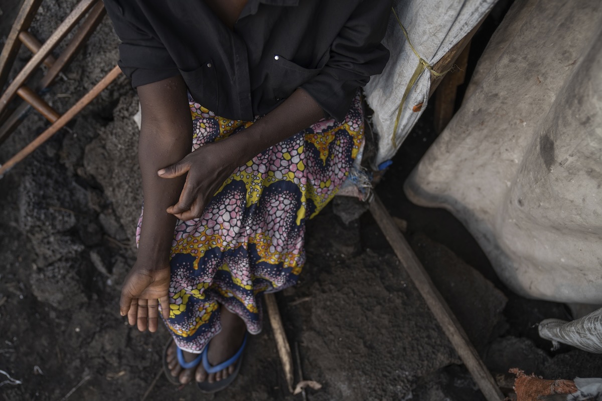 Democratische Republiek Congo worstelt met mpox-uitbraak ANP 506089671
